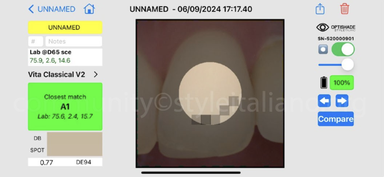 Điều Trị Lại Một Mão Răng Trên Implant: Tối ưu hoá kết quả bằng phần mềm OptiShade